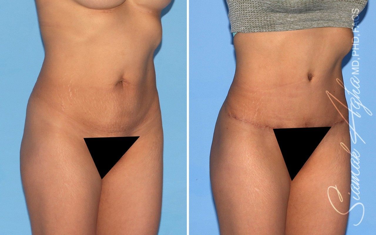 Combined Tummy Tuck Brazilian Butt Lift Before & After