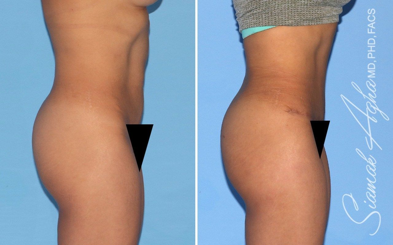 Combined Tummy Tuck Brazilian Butt Lift Before & After