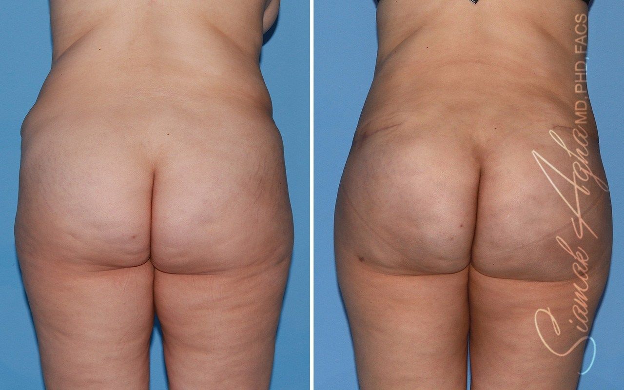 Combined Tummy Tuck Brazilian Butt Lift Before & After