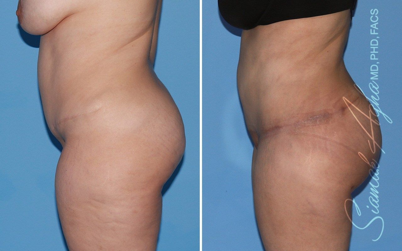 Combined Tummy Tuck Brazilian Butt Lift Before & After