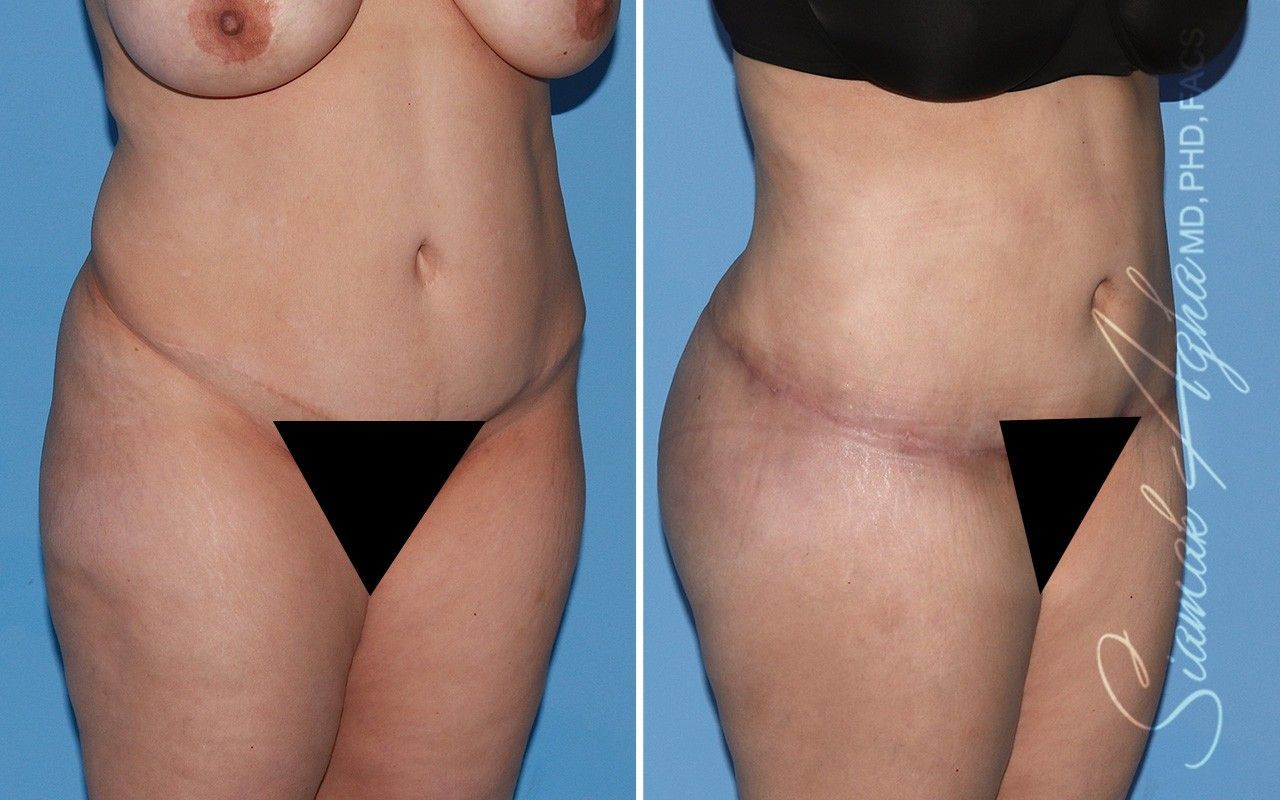 Combined Tummy Tuck Brazilian Butt Lift Before & After