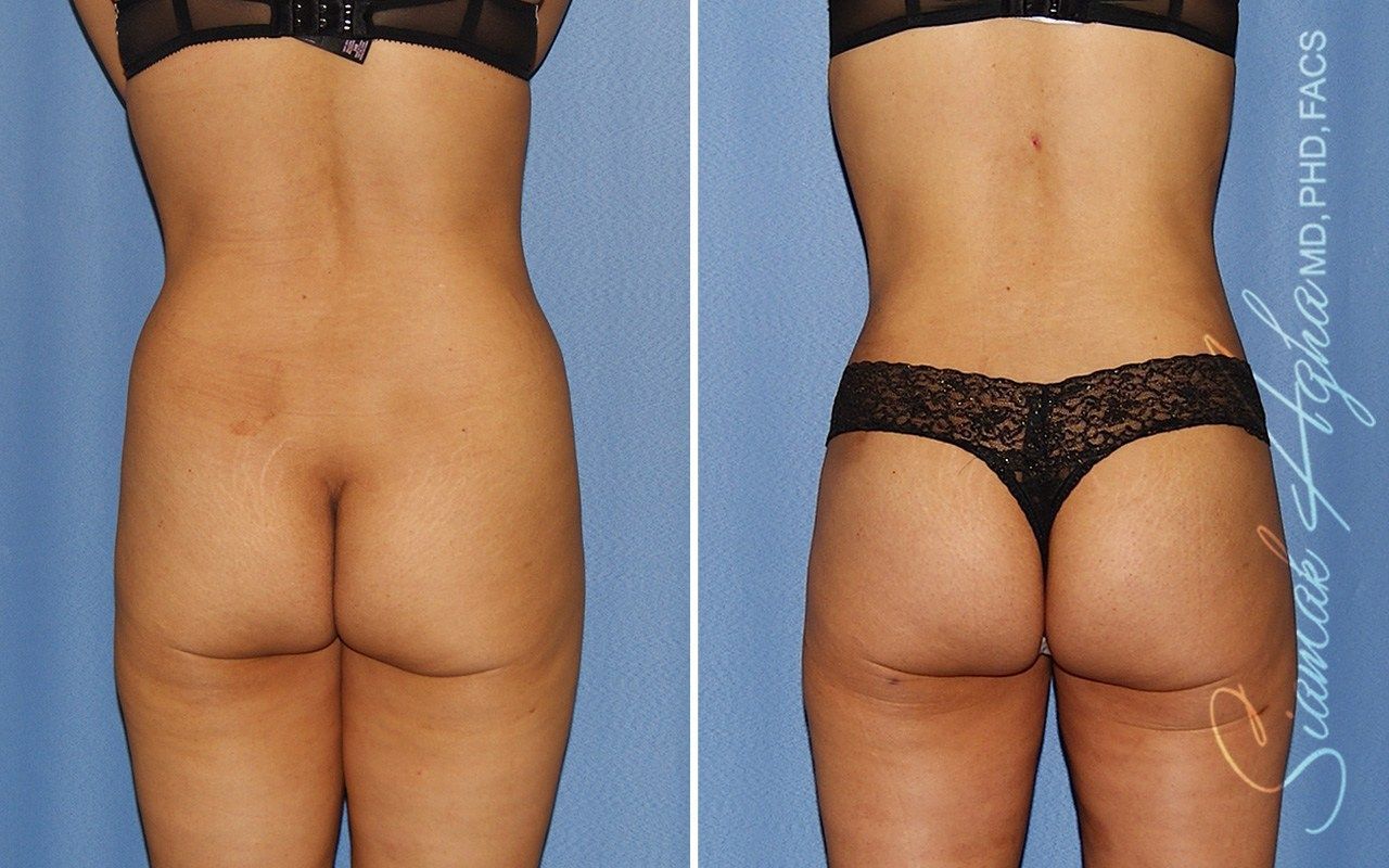Combined Tummy Tuck Brazilian Butt Lift Before & After