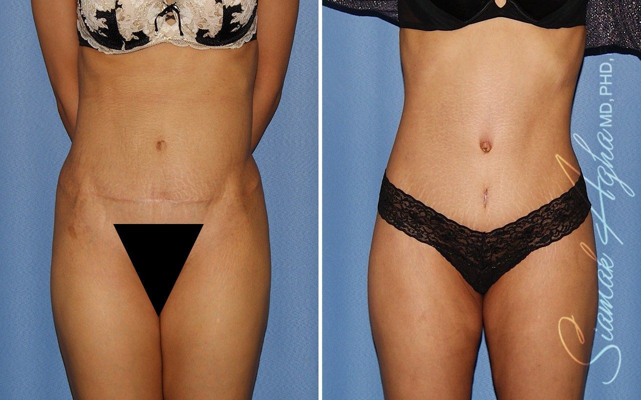 Combined Tummy Tuck Brazilian Butt Lift Before & After