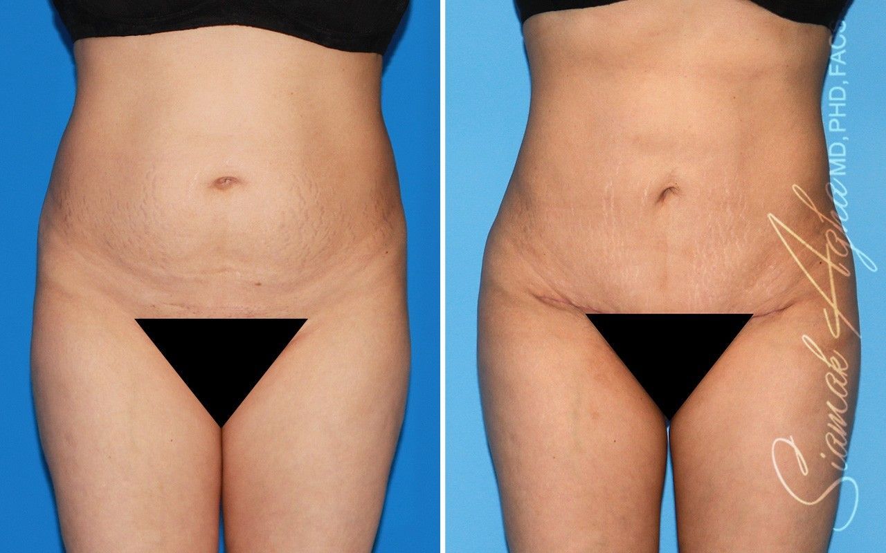 Combined Tummy Tuck Brazilian Butt Lift Before & After