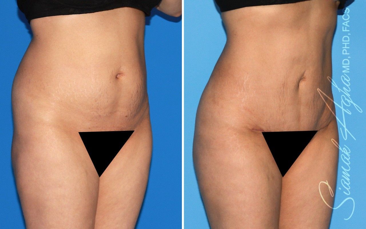 Combined Tummy Tuck Brazilian Butt Lift Before & After