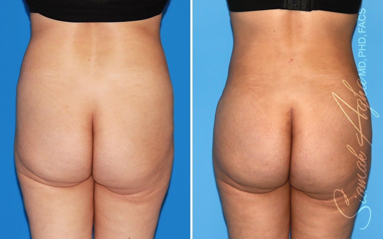 Combined Tummy Tuck Brazilian Butt Lift Before & After