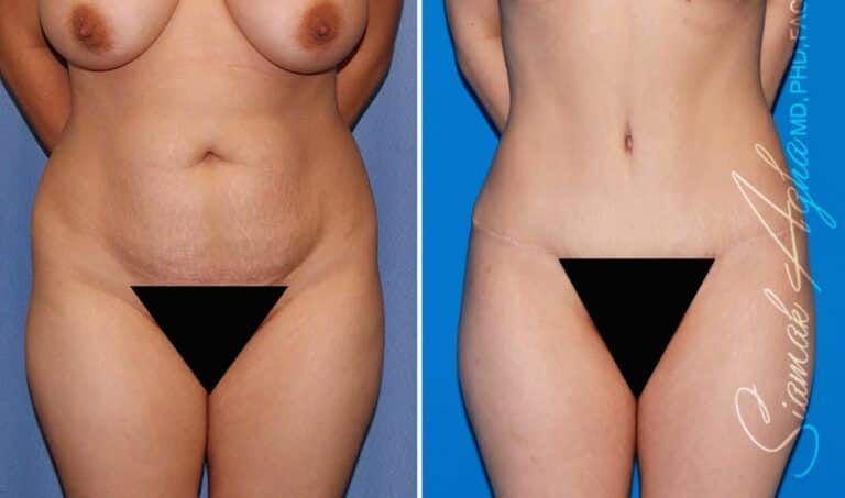 Combined Tummy Tuck Brazilian Butt Lift Before & After