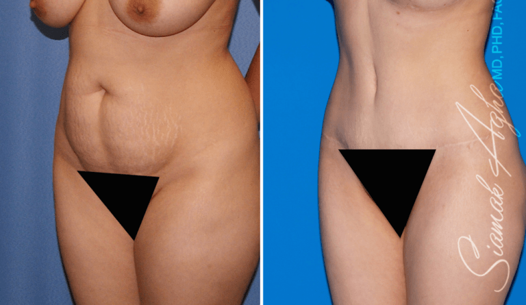 Combined Tummy Tuck Brazilian Butt Lift Before & After