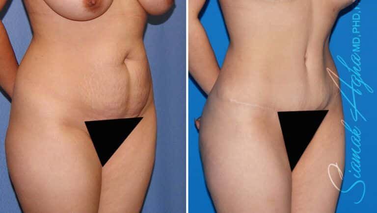 Combined Tummy Tuck Brazilian Butt Lift Before & After