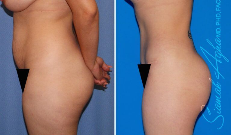 Combined Tummy Tuck Brazilian Butt Lift Before & After