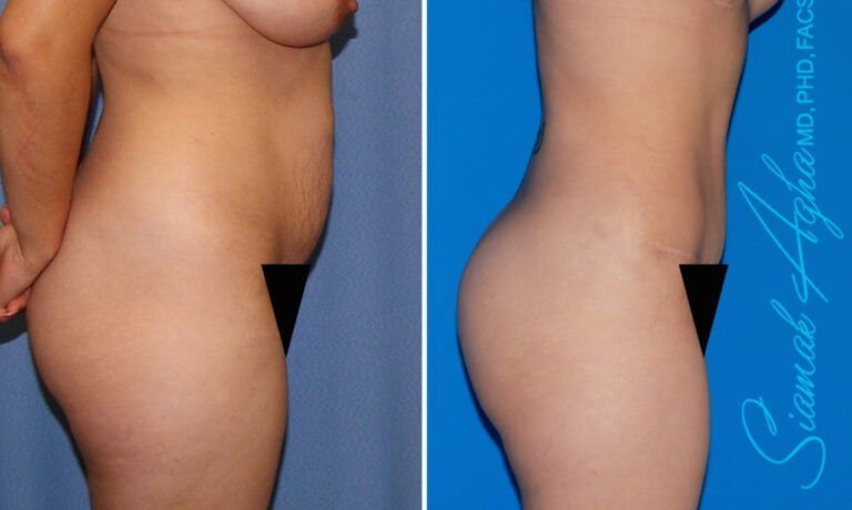 Combined Tummy Tuck Brazilian Butt Lift Before & After