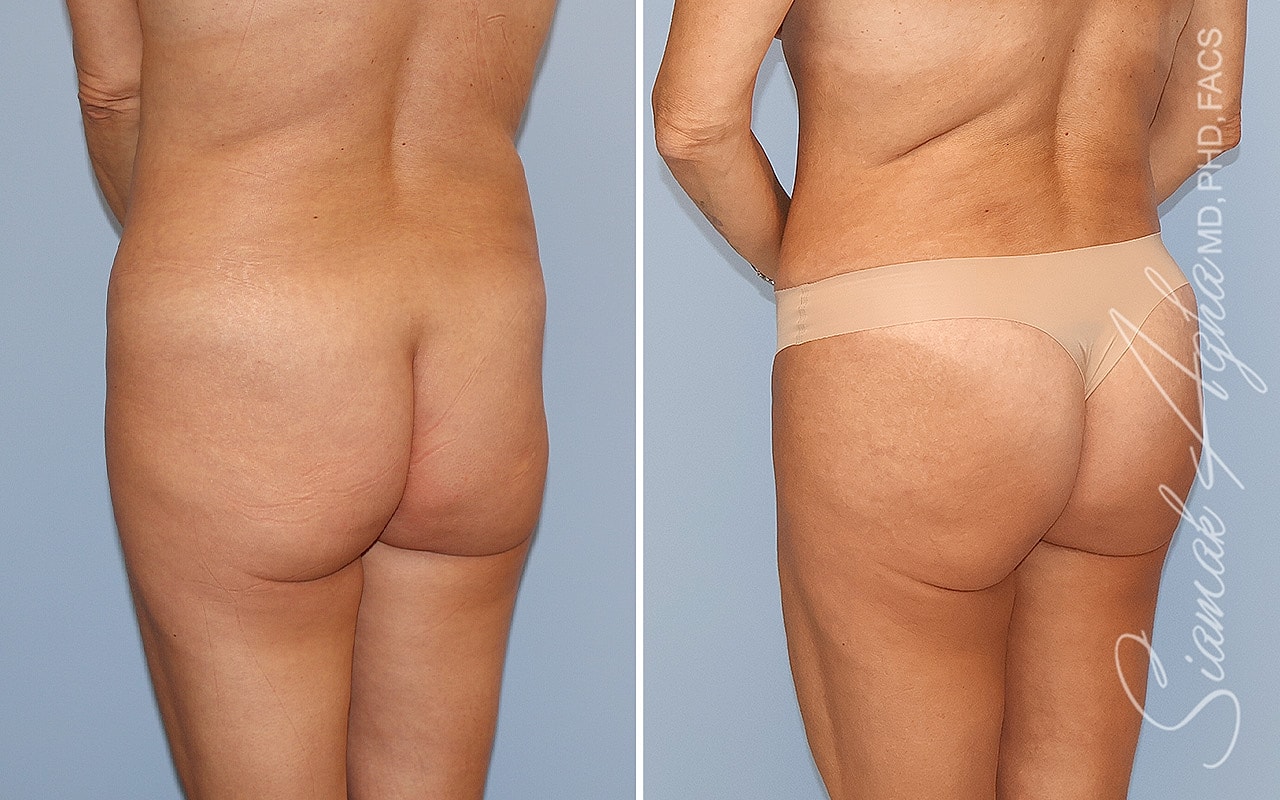 Before and after body contouring results