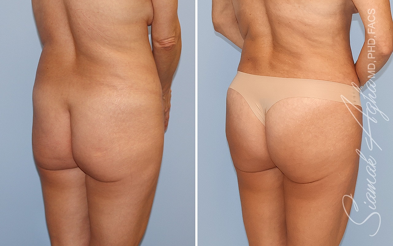 Before and after body contouring transformation.