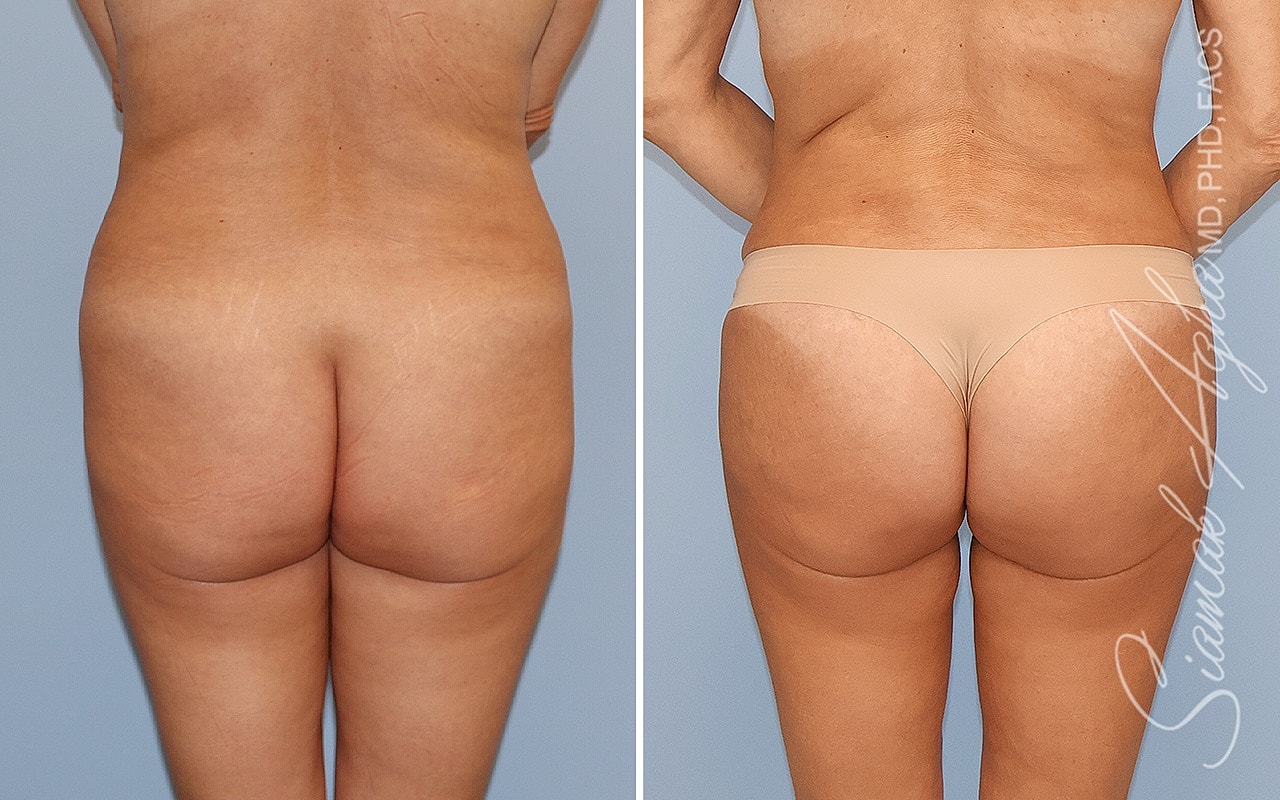 Before and after body contouring results