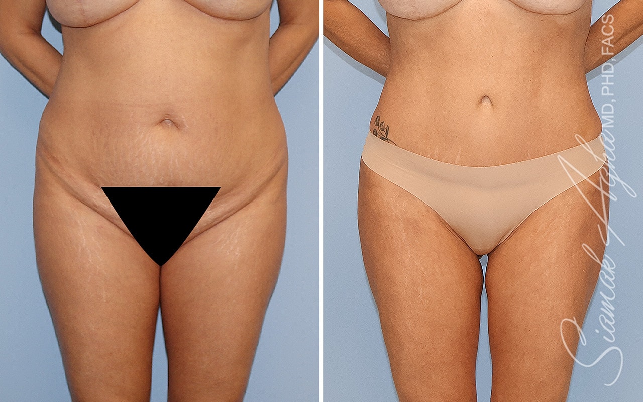Before and after body contouring results.