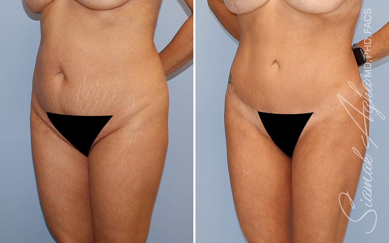 Before and after body contouring comparison.