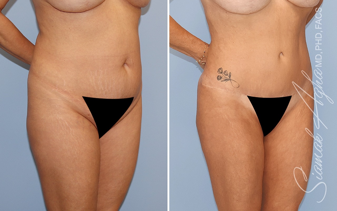 Before and after body contouring transformation.