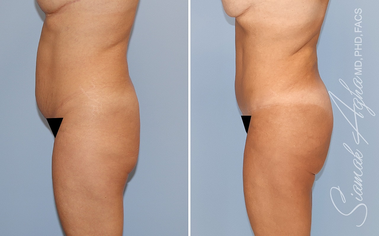 Before and after body contouring transformation comparison.