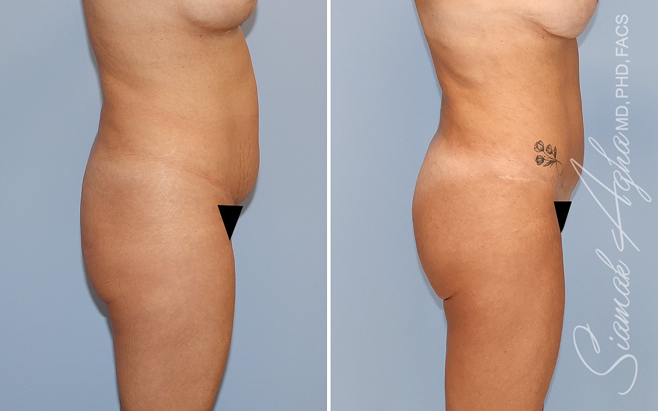 Before-and-after body contouring results side view.