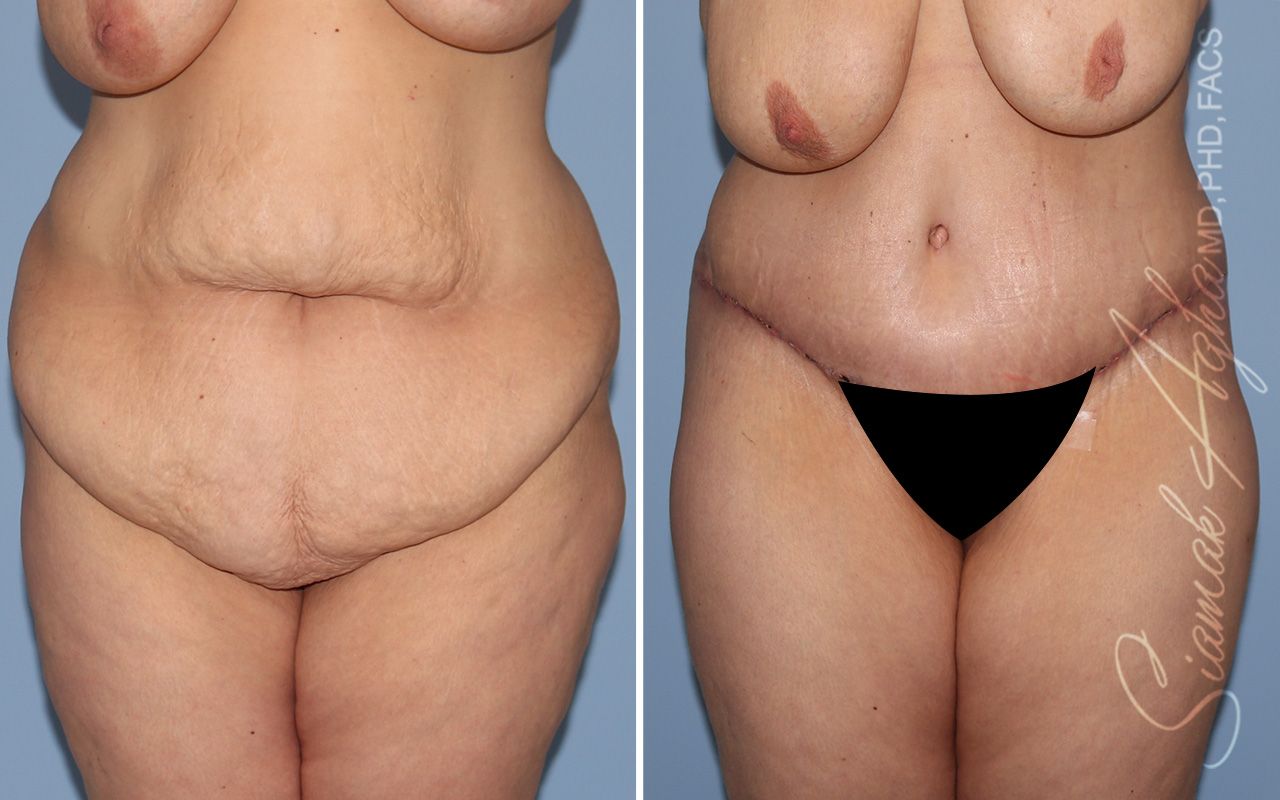 Plus Size Tummy Tuck Before & After