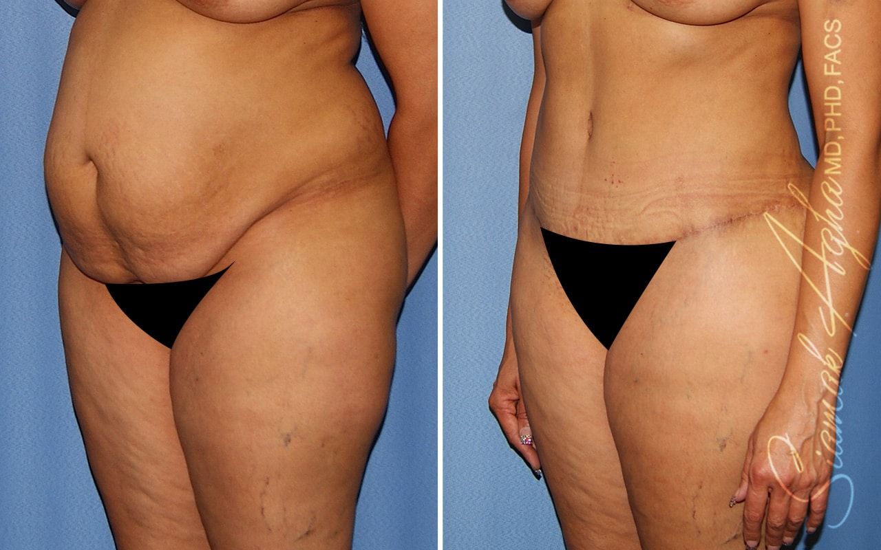 Plus Size Tummy Tuck Before & After