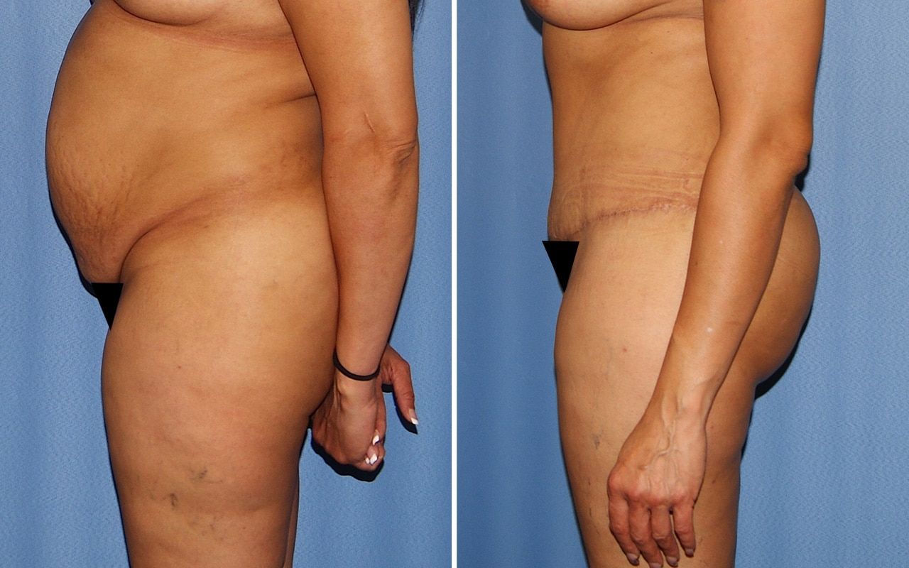 Plus Size Tummy Tuck Before & After