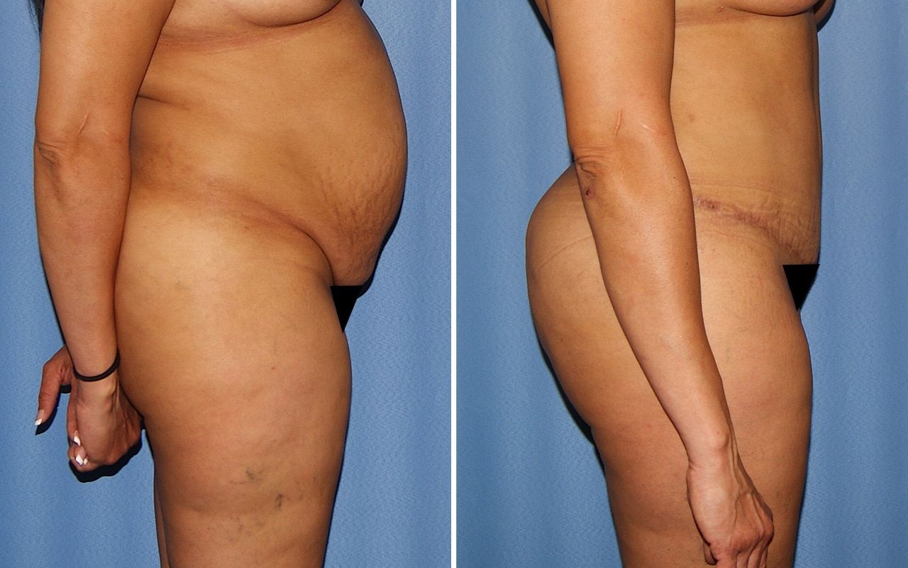 Plus Size Tummy Tuck Before & After