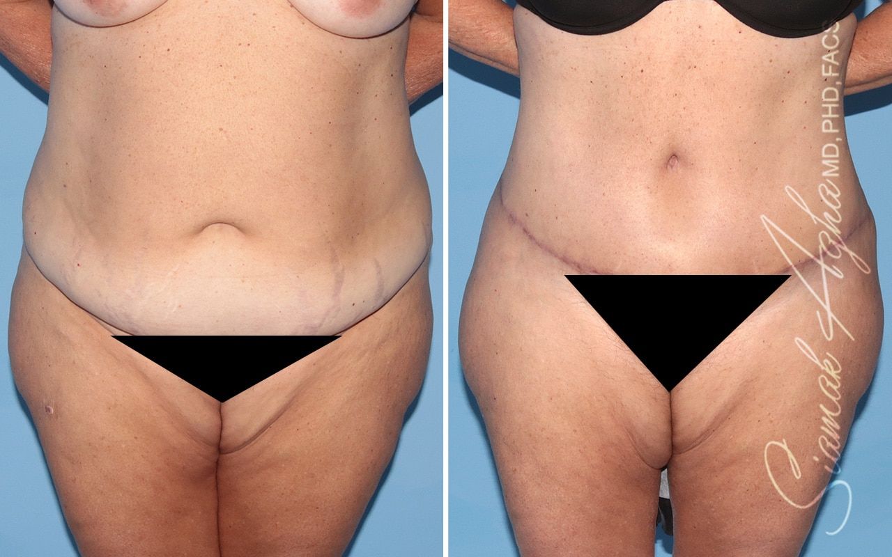Plus Size Tummy Tuck Before & After