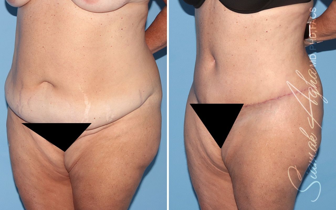Plus Size Tummy Tuck Before & After