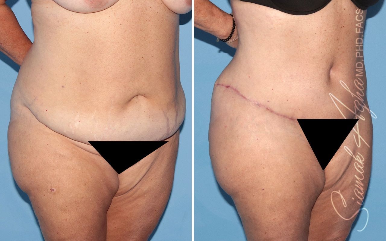 Plus Size Tummy Tuck Before & After