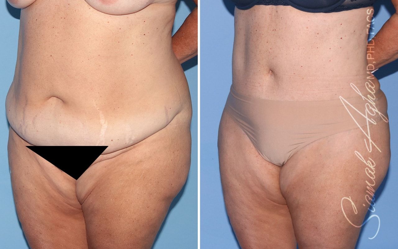 Plus Size Tummy Tuck Before & After