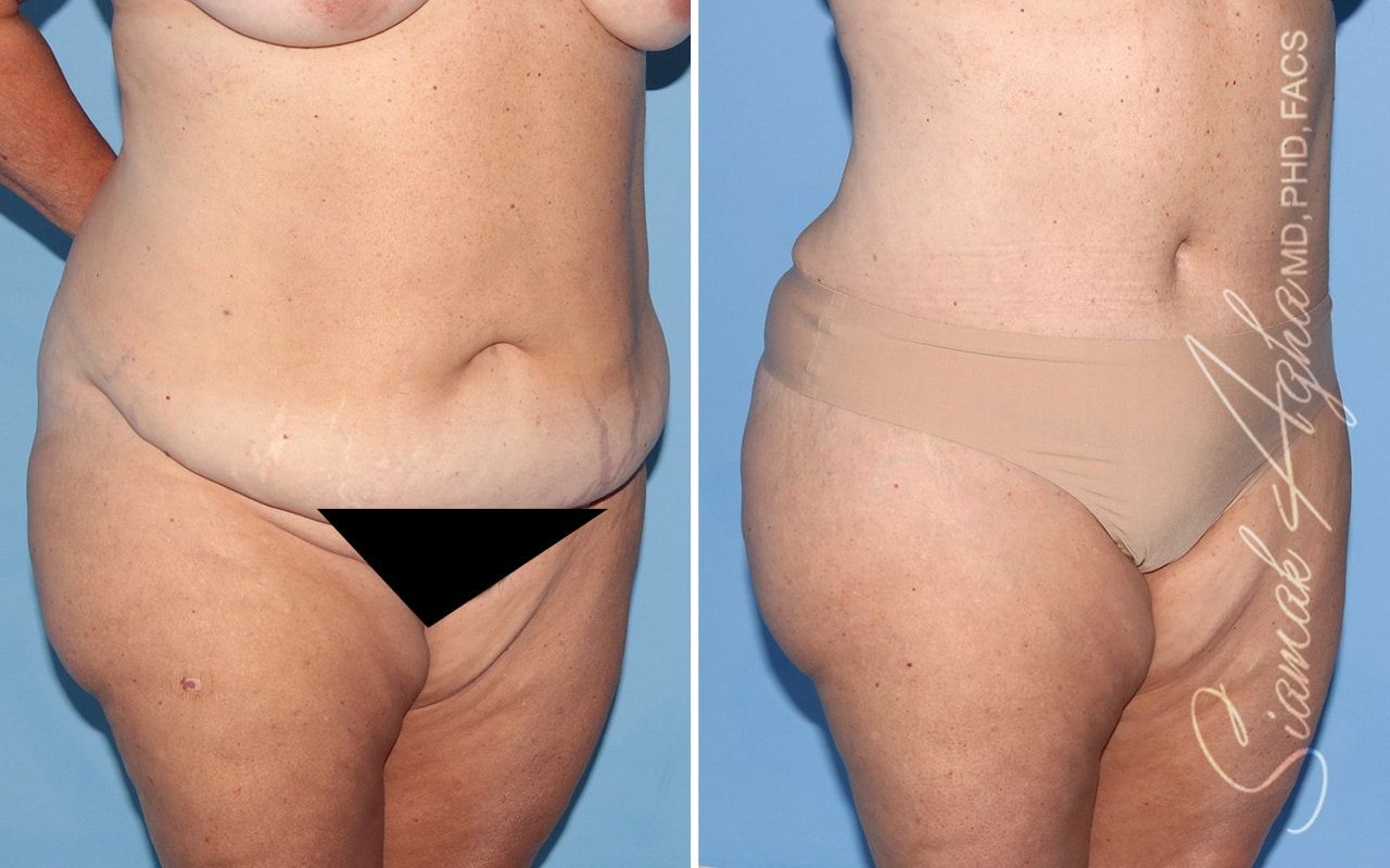 Plus Size Tummy Tuck Before & After