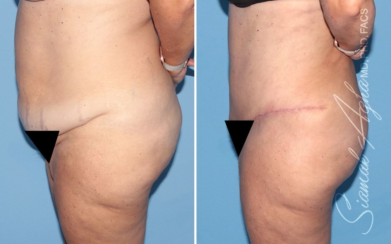 Plus Size Tummy Tuck Before & After