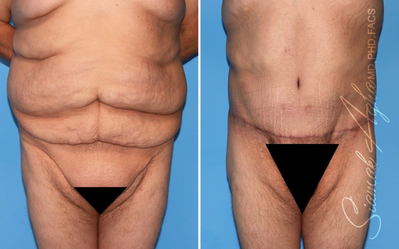 Plus Size Tummy Tuck Before & After