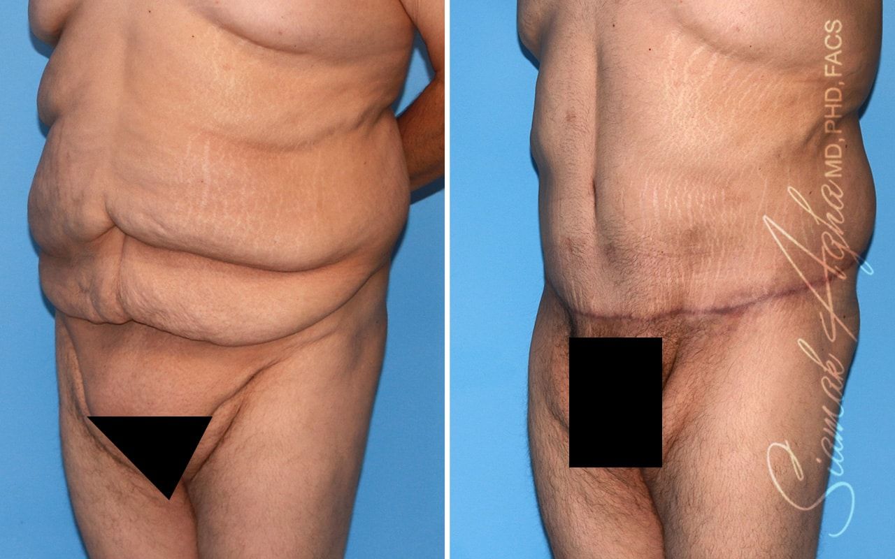 Plus Size Tummy Tuck Before & After