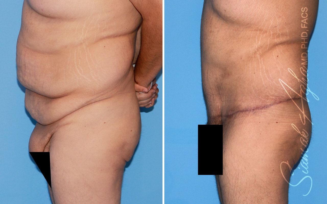 Plus Size Tummy Tuck Before & After