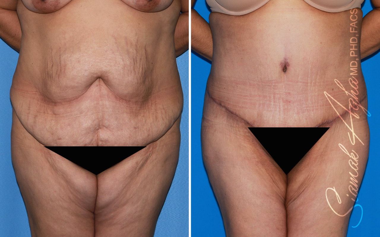 Plus Size Tummy Tuck Before & After
