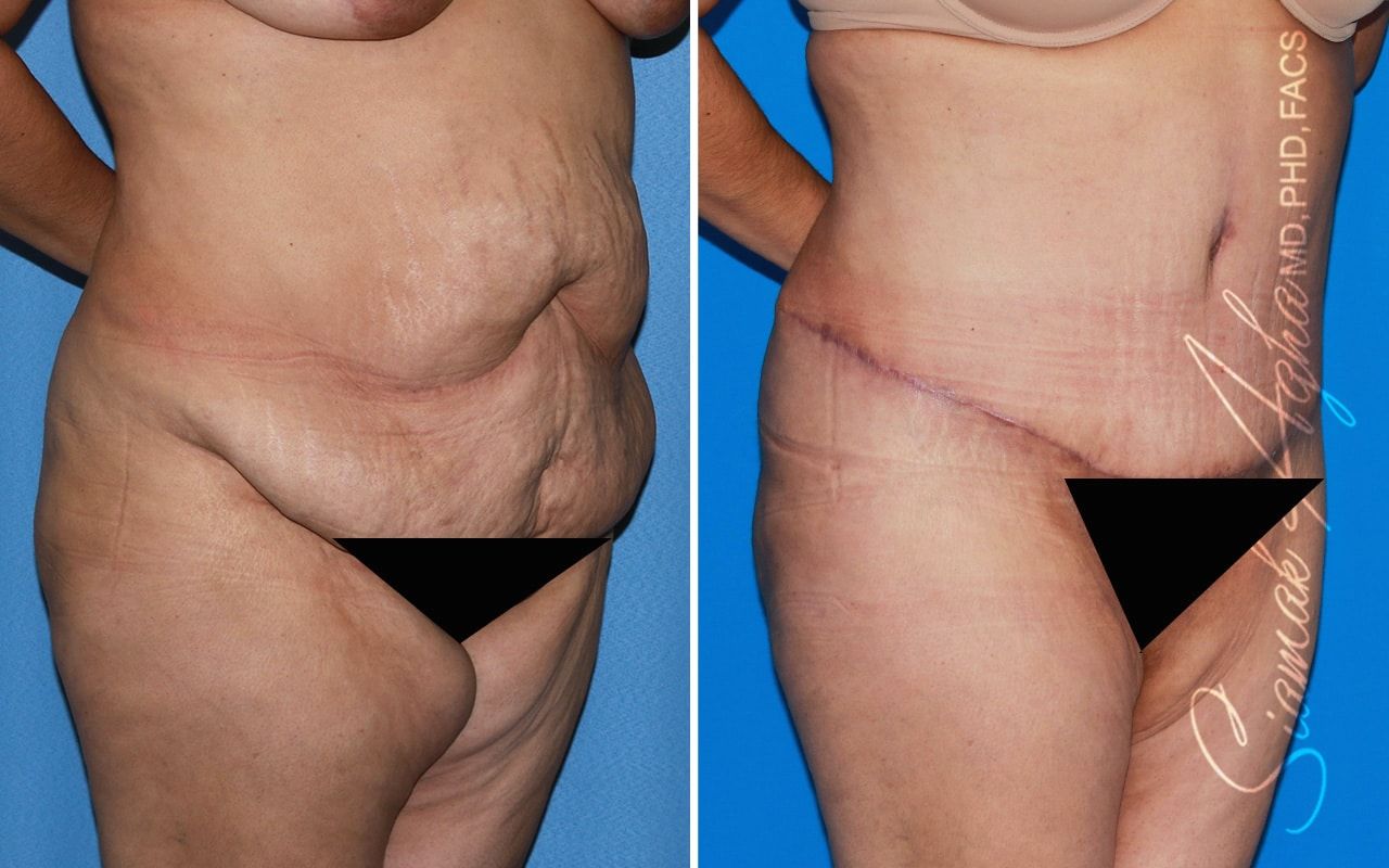Plus Size Tummy Tuck Before & After