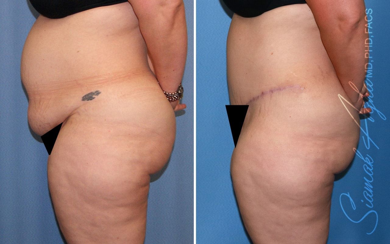Plus Size Tummy Tuck Before & After