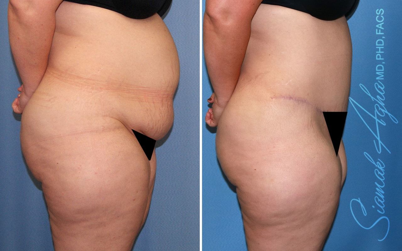Plus Size Tummy Tuck Before & After
