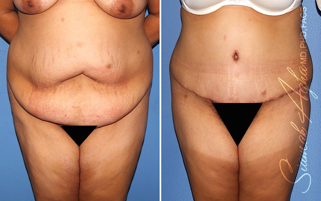 Plus Size Tummy Tuck Before & After