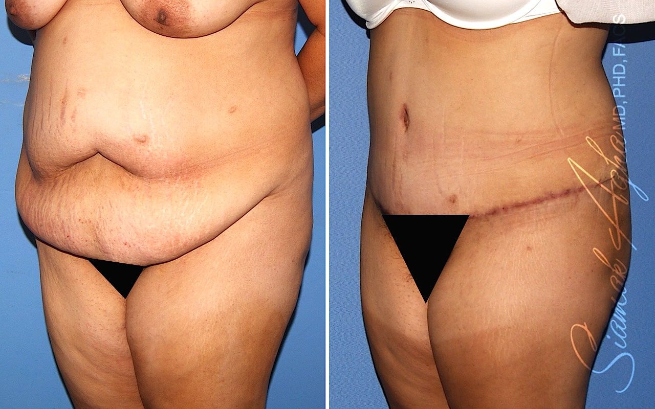 Plus Size Tummy Tuck Before & After