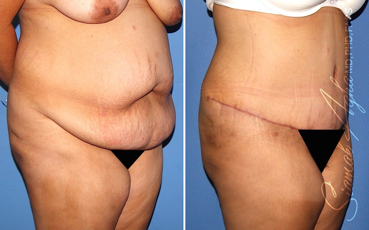 Plus Size Tummy Tuck Before & After