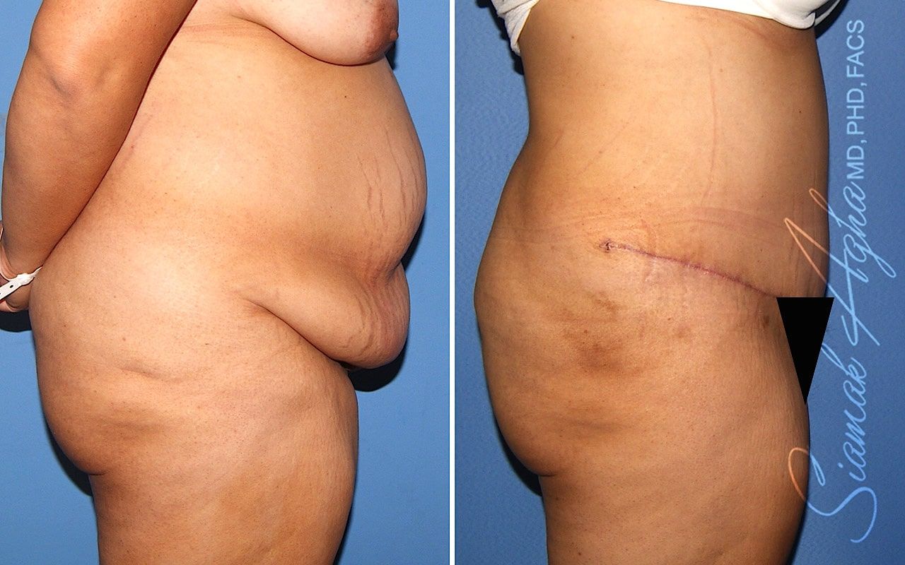 Plus Size Tummy Tuck Before & After