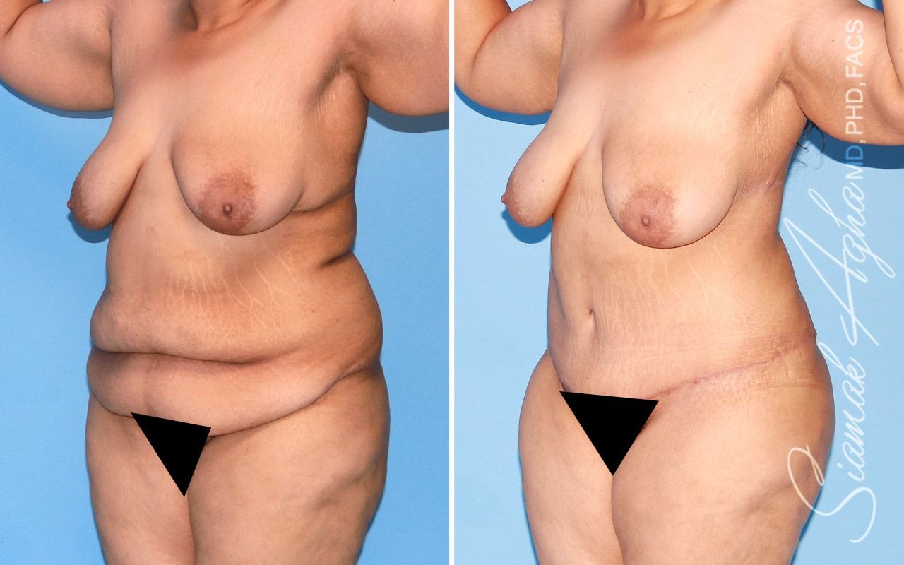 Plus Size Tummy Tuck Before & After