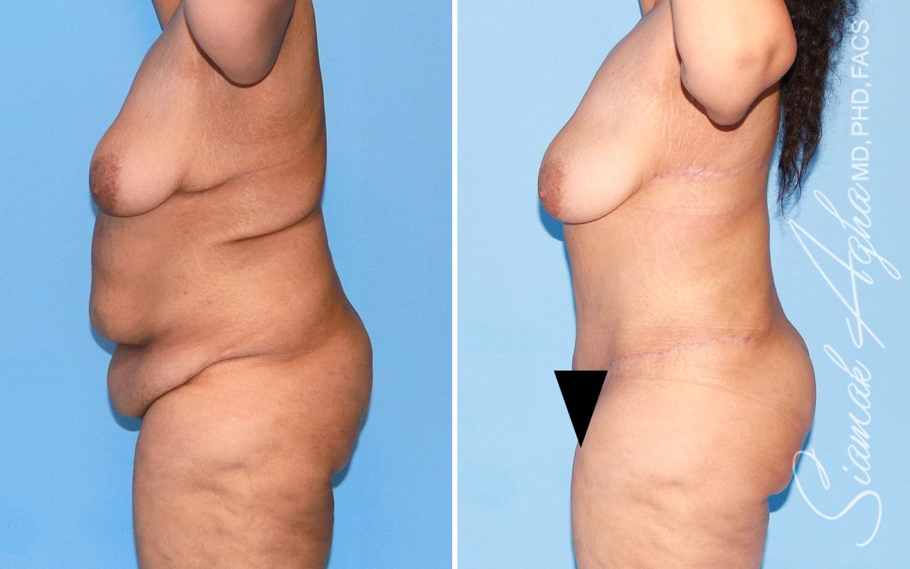 Plus Size Tummy Tuck Before & After