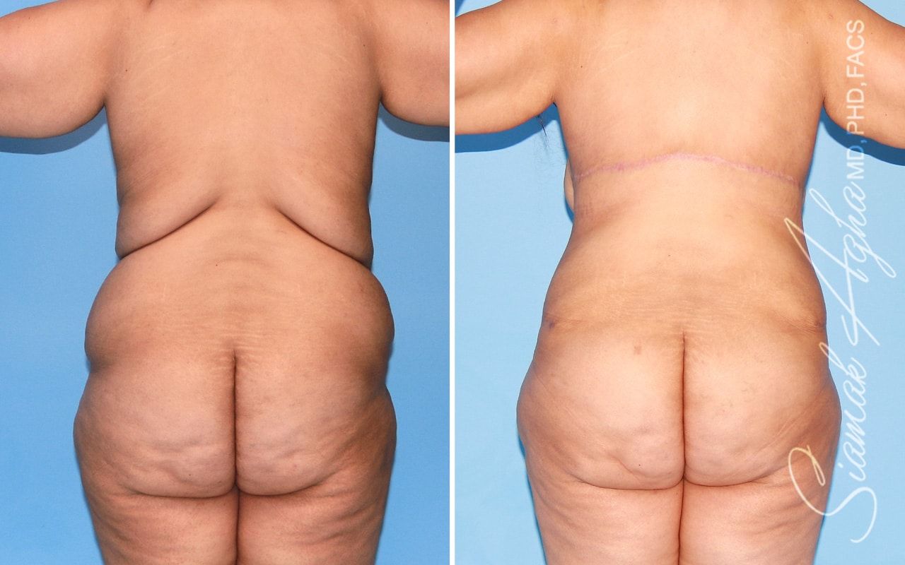 Plus Size Tummy Tuck Before & After
