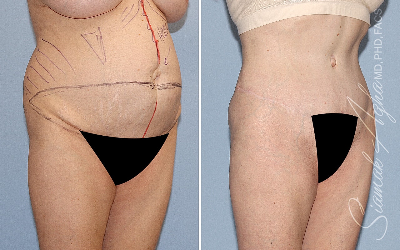 Plus Size Tummy Tuck Before & After