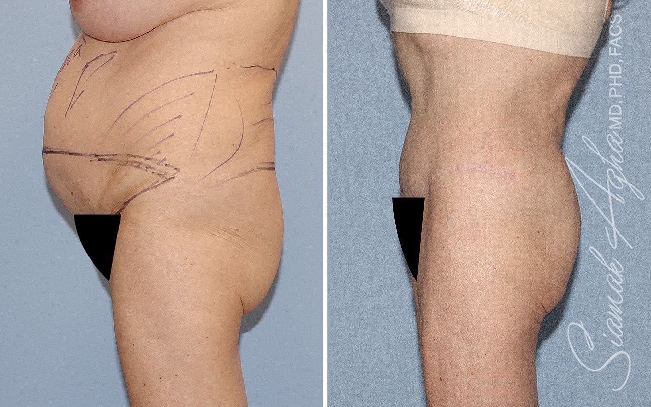 Plus Size Tummy Tuck Before & After