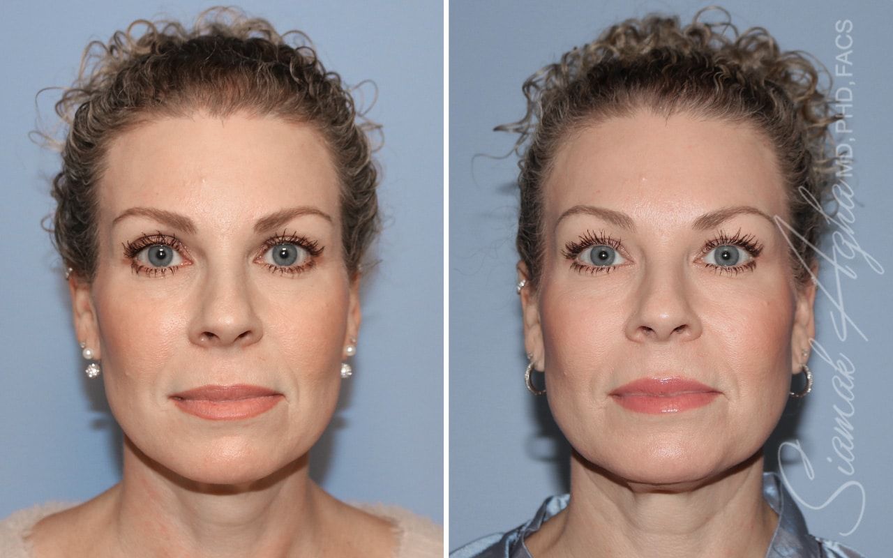 Ellacor Before & After